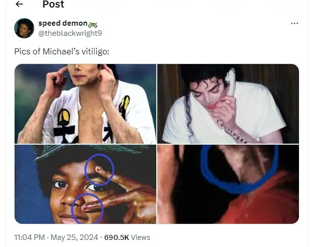 vitiligo