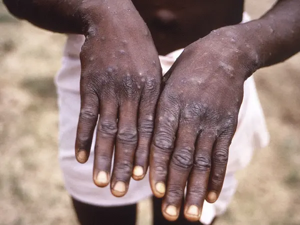 Κρούσμα mpox στο Κονγκό