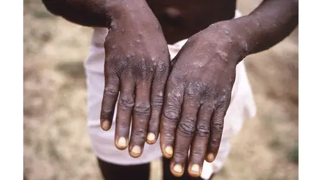 Κρούσμα mpox στο Κονγκό